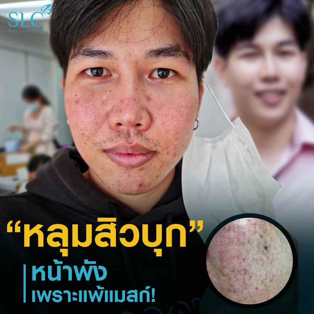 Fraxel_Ematrix_รีวิวรักษาสิว_รักษาหลุมสิว_หลุมสิว_แพ้แมสก์