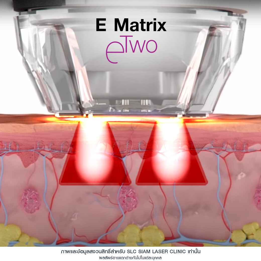 สิว_รอยหลุมสิว_รักษาสิว_Fraxel_Ematrix_เลเซอร์สิว