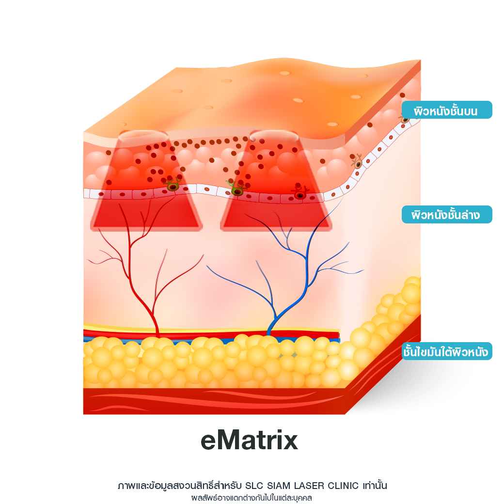 E Matrix ETWO_รักษาหลุมสิว_รักษาสิว_หลุมสิว