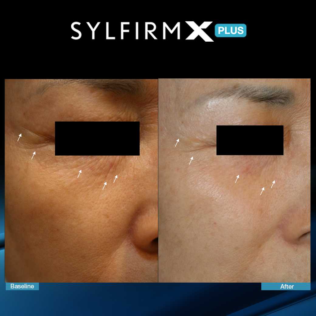 Sylfirm X Plus, กระชับรูขุมขน, ลดฝ้า, จุดด่างดำ, ลดรอยแดง, หลุมสิว,งานผิว,ผิวใส,ลดกระ,ลดจุดด่างดำ,ลดรอยดำ,ผิวเนียน,