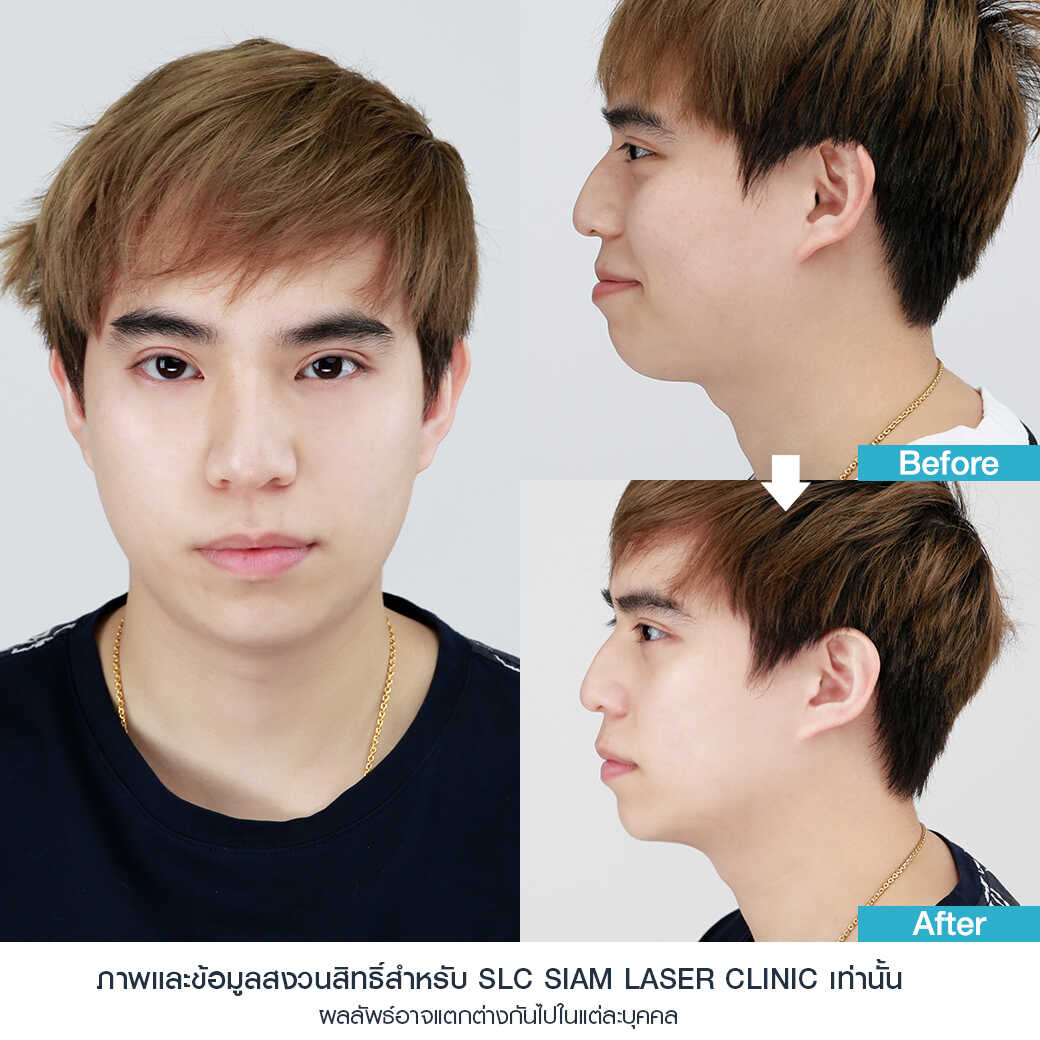 ยกกระชับ Thermage FLX