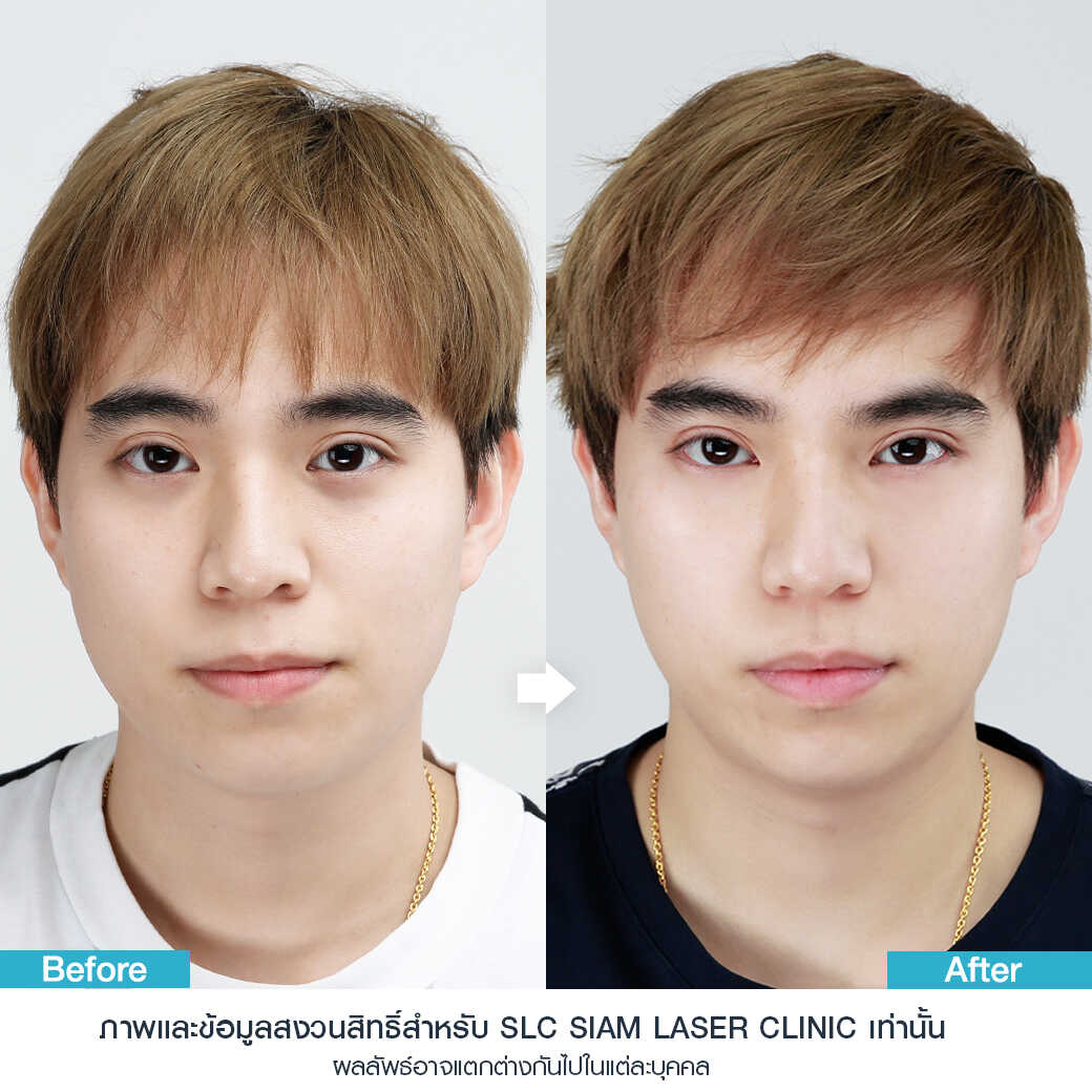 ยกกระชับ Thermage FLX