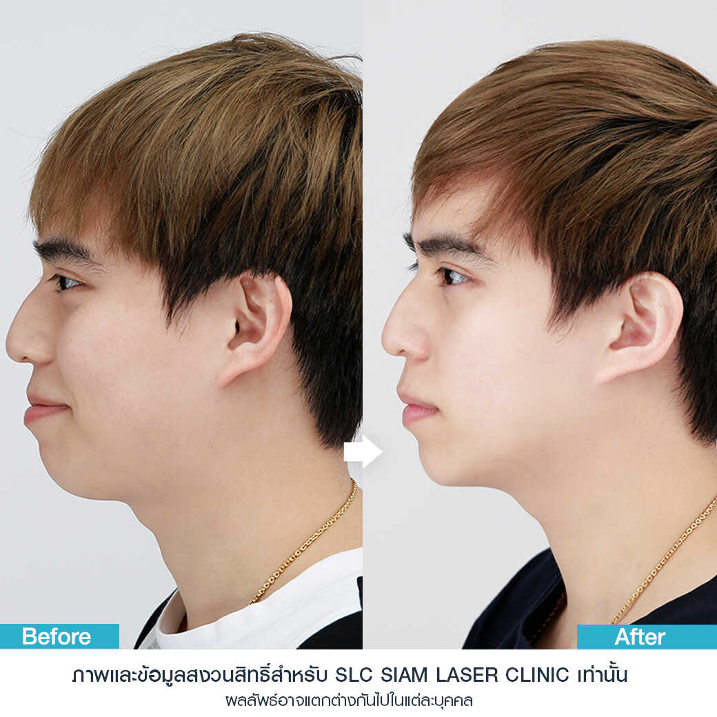 ยกกระชับ Thermage FLX