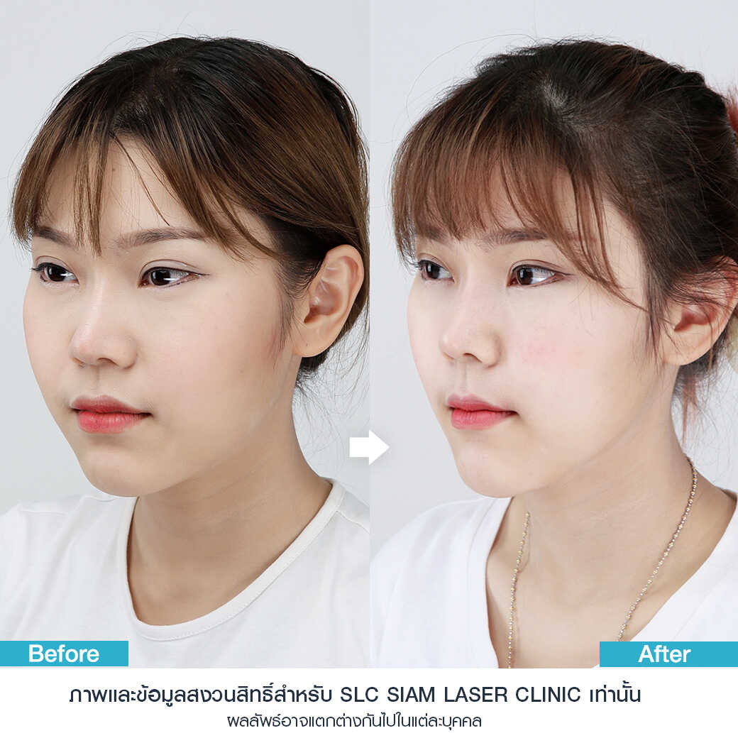 ยกกระชับ Thermage FLX