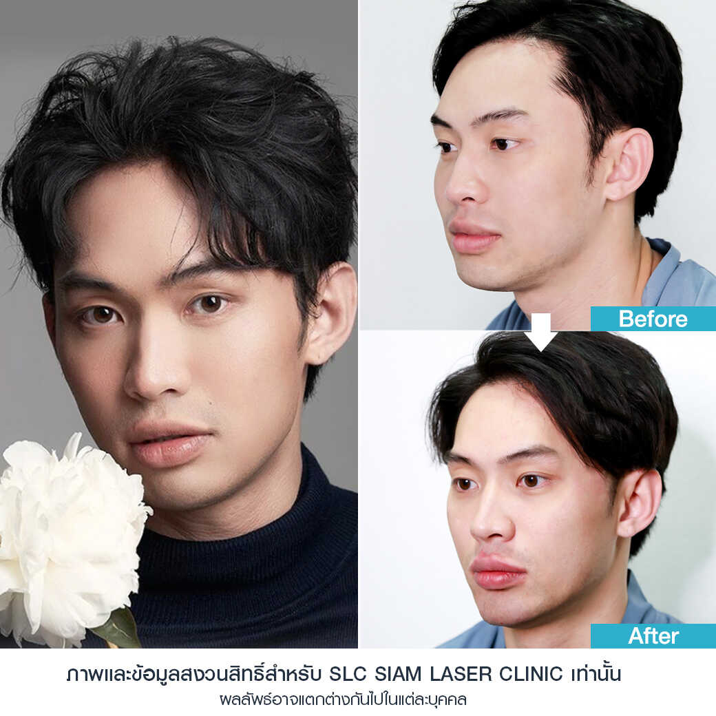 ยกกระชับ Thermage FLX