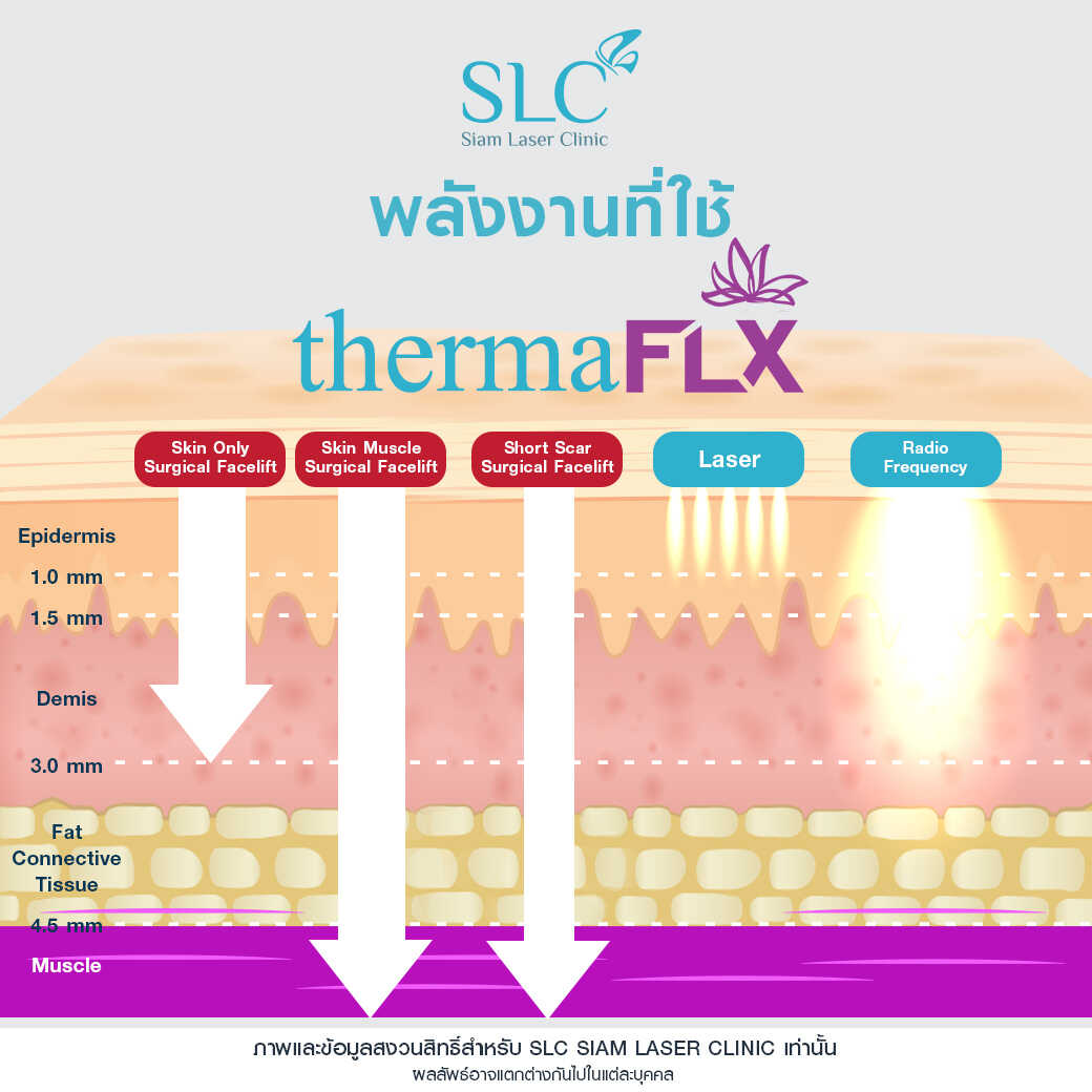 ยกกระชับ Thermage FLX