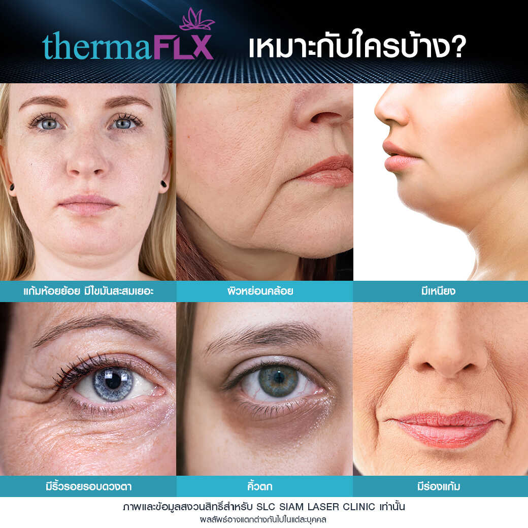 ยกกระชับ Thermage FLX