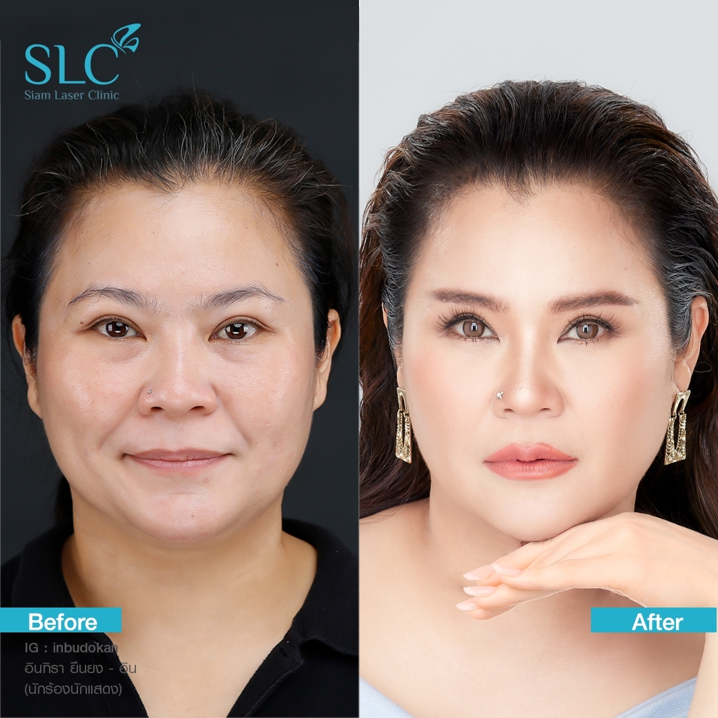 Ultherapy SPT ยกกระชับ