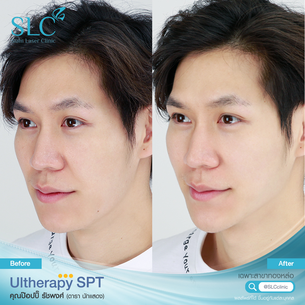 Ultherapy SPT ยกกระชับ