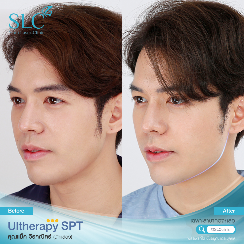 Ultherapy SPT ยกกระชับ