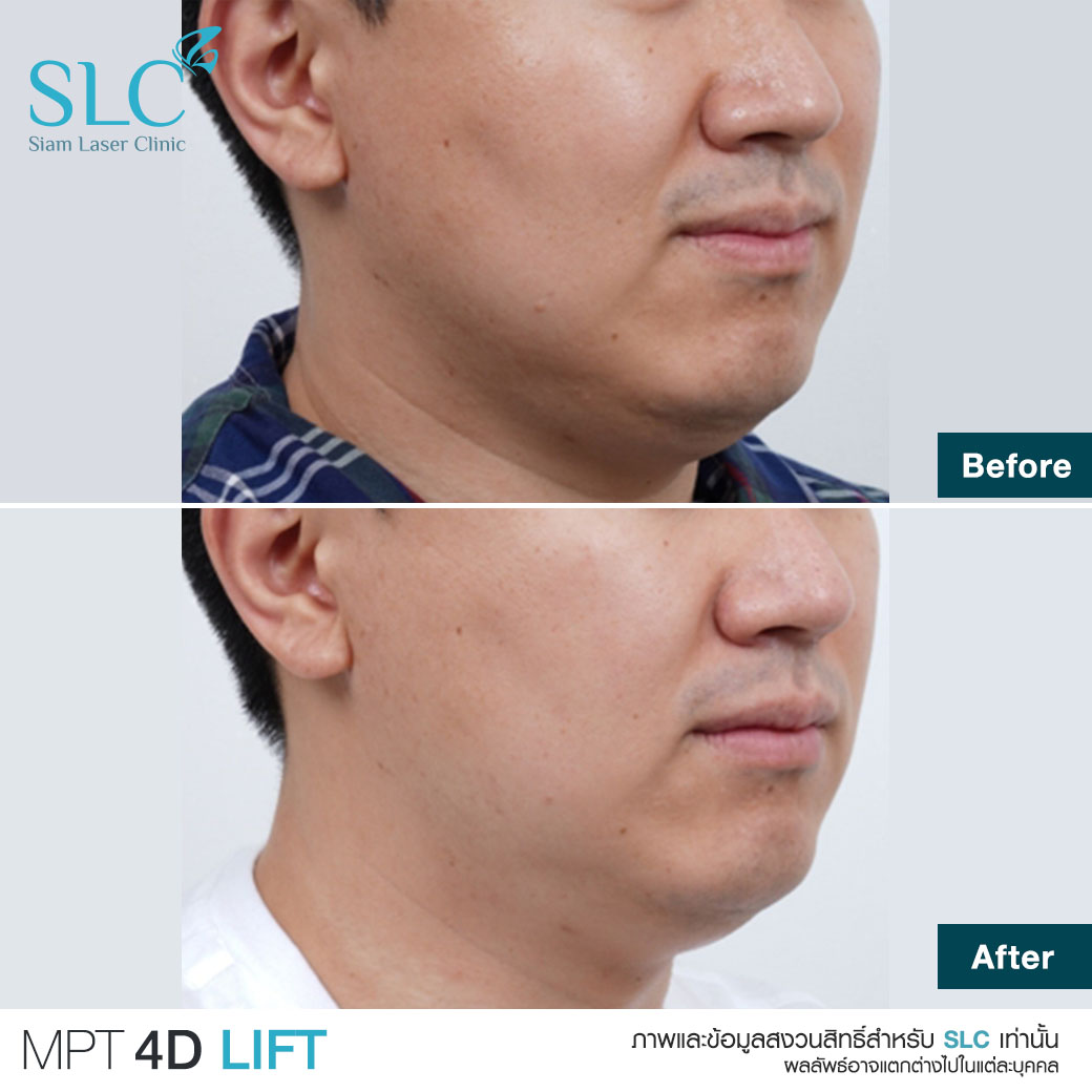 MPT4D Lift_ยกกระชับหน้า_Ultra former_Ultralift 