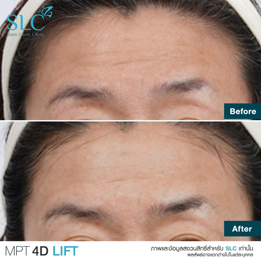 MPT4D Lift_ยกกระชับหน้า_Ultra former_Ultralift