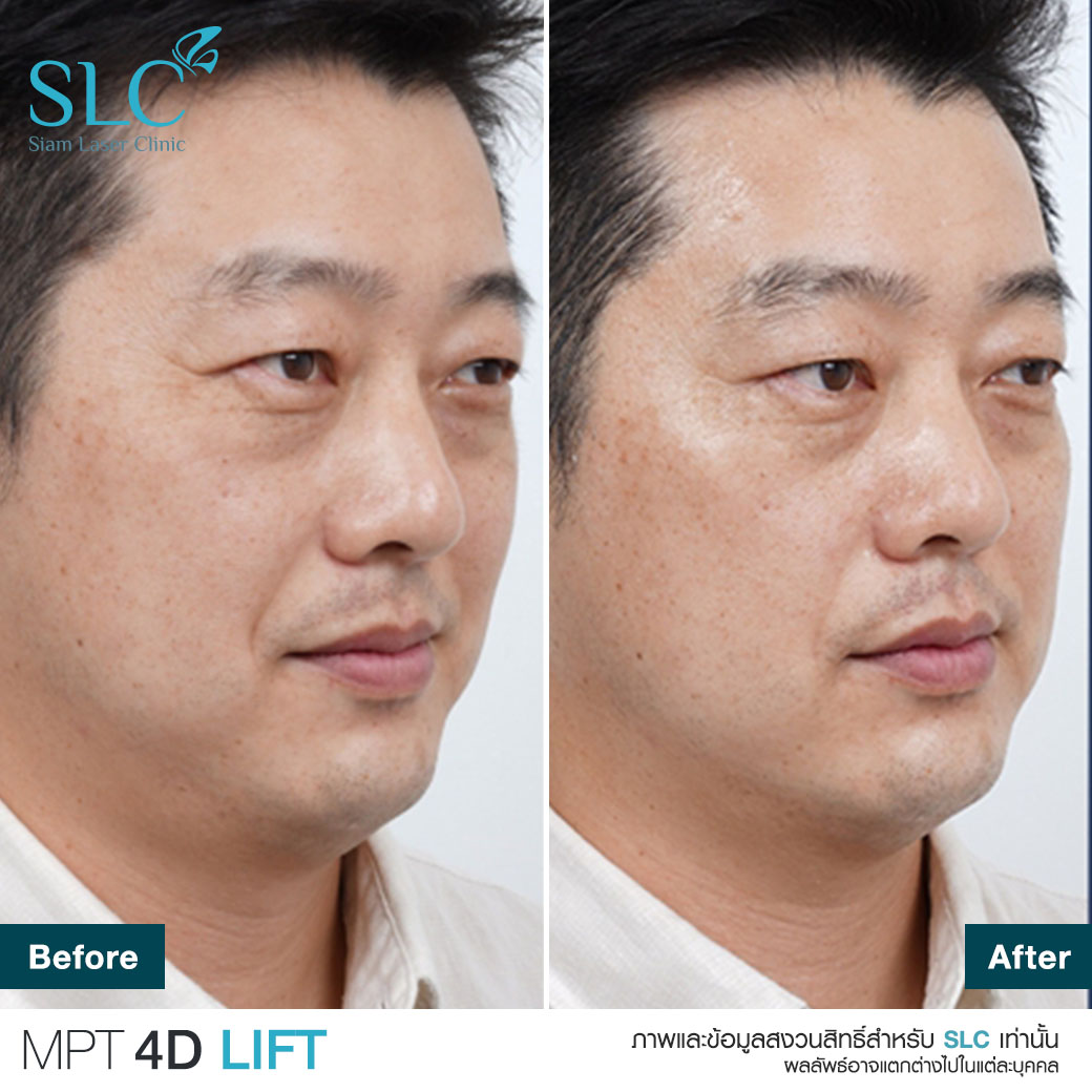 MPT4D Lift_ยกกระชับหน้า_Ultra former_Ultralift 