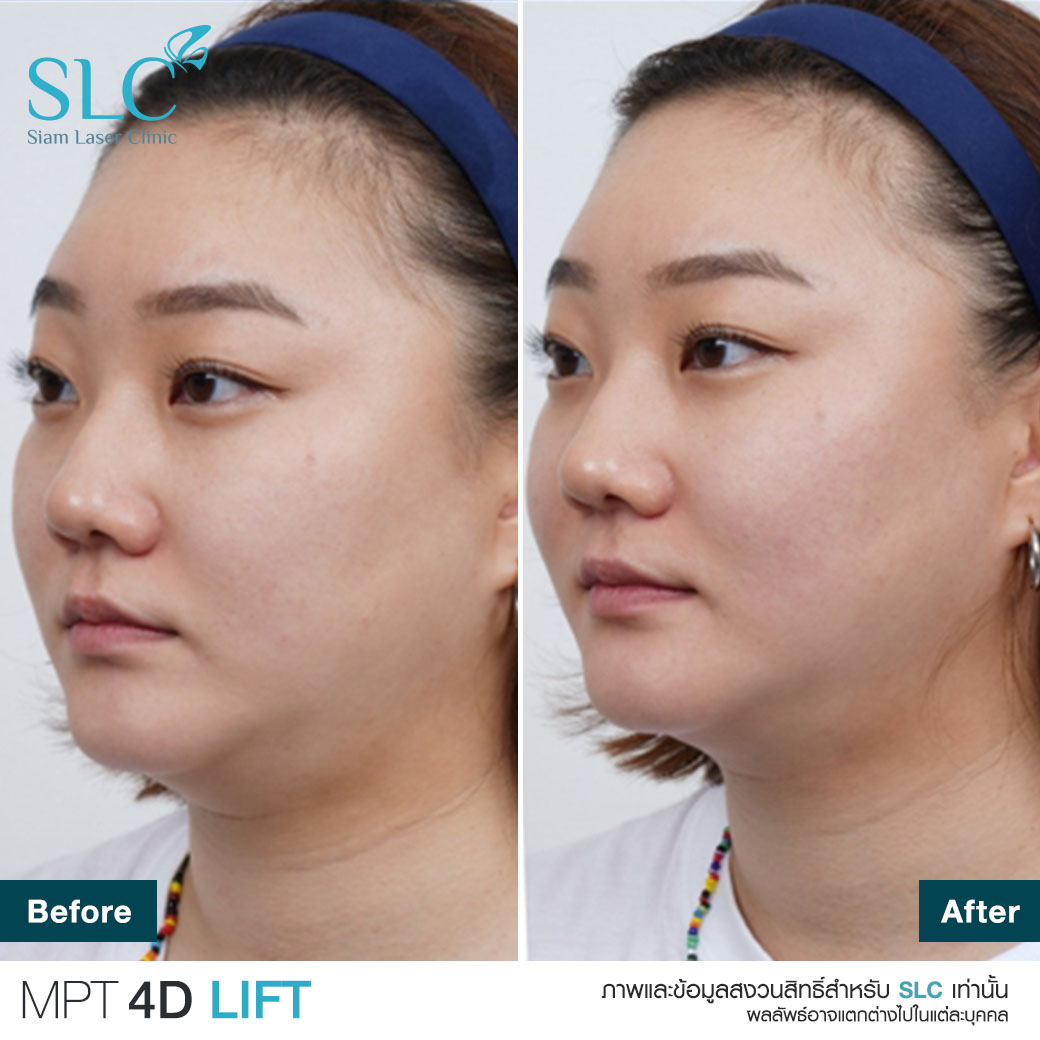 MPT4D Lift_ยกกระชับหน้า_Ultra former_Ultralift 