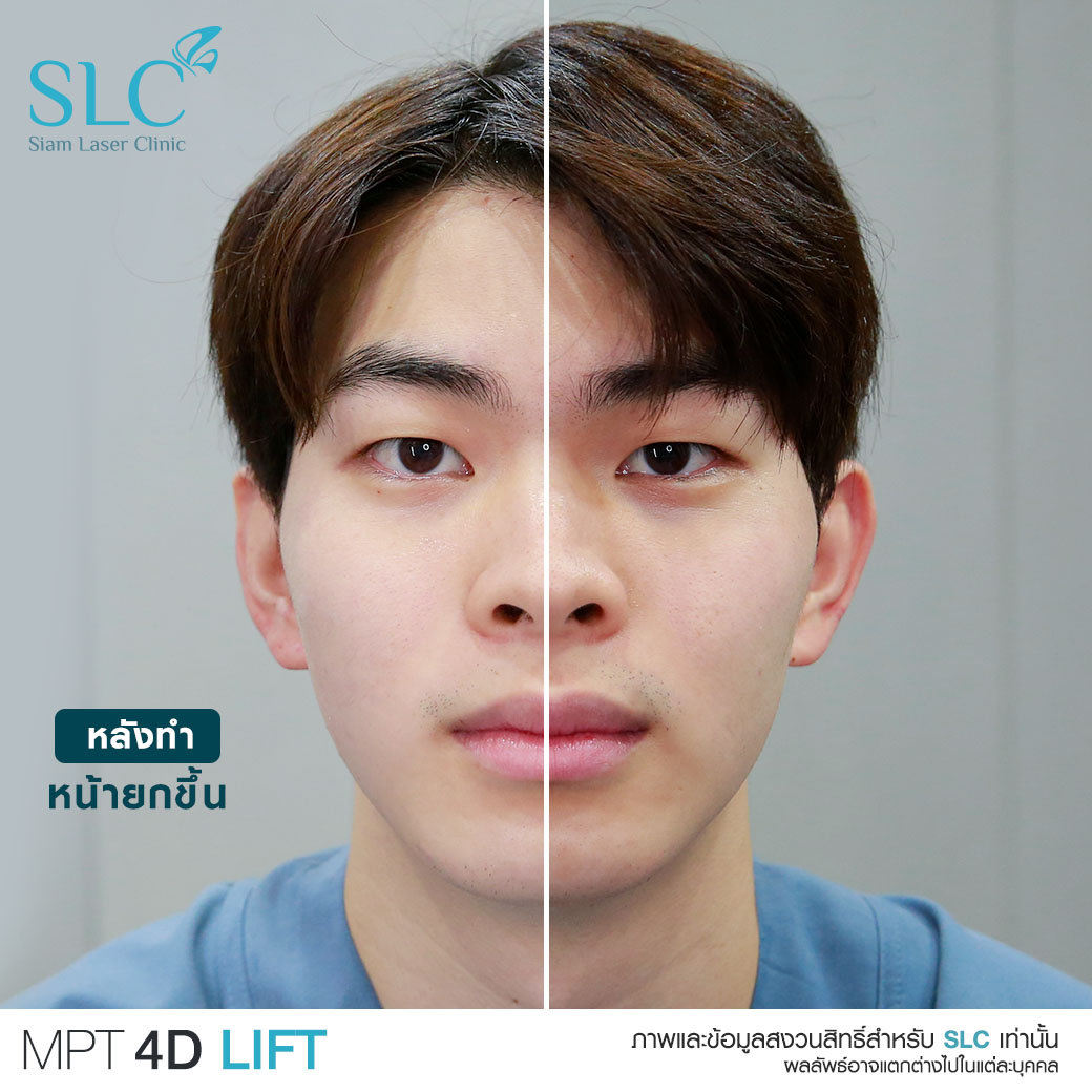 MPT4D Lift_ยกกระชับหน้า_Ultra former_Ultralift 