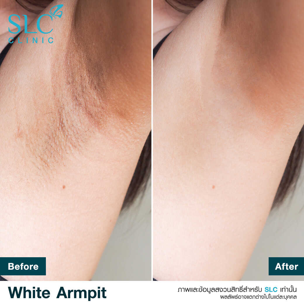 White Armpit Program_โปรแกรม รักแร้ขาว