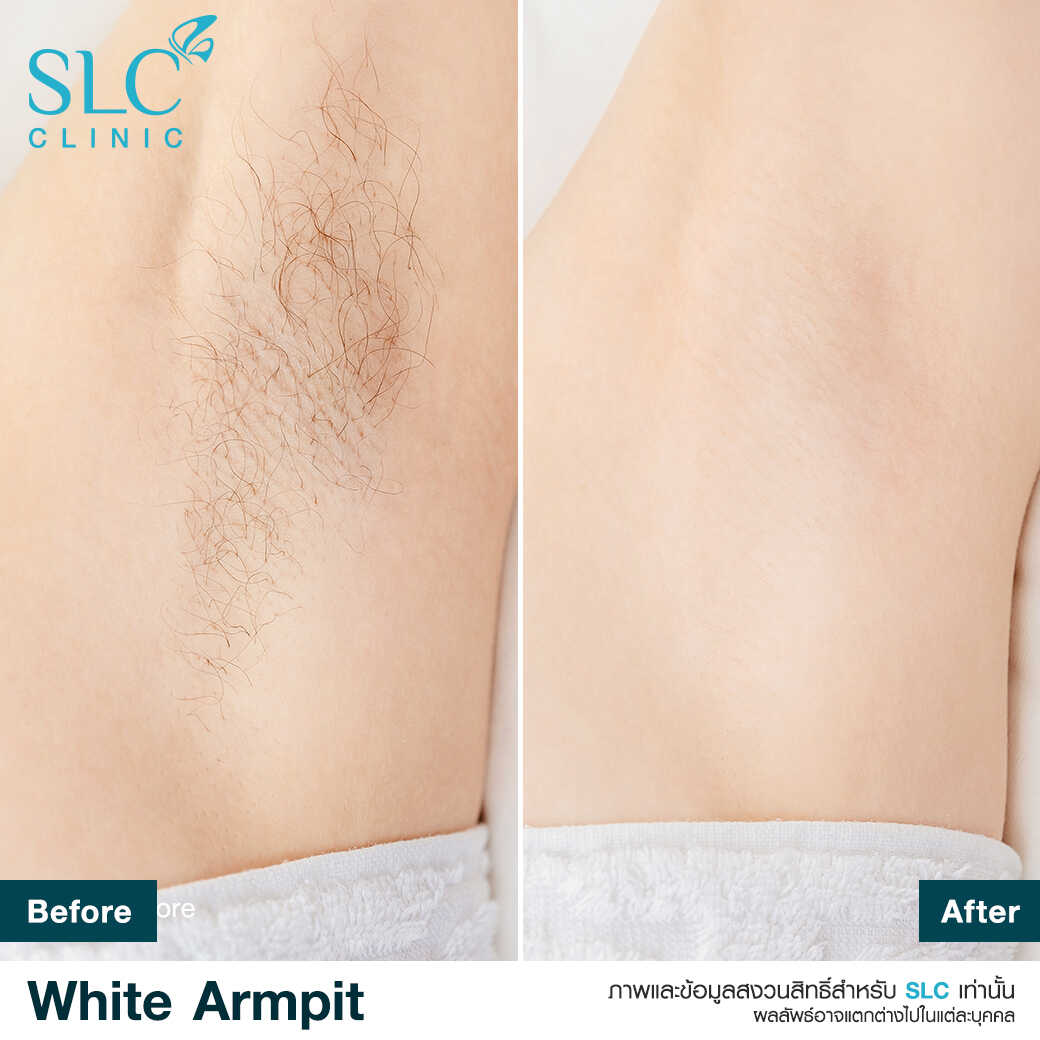 White Armpit Program_โปรแกรม รักแร้ขาว