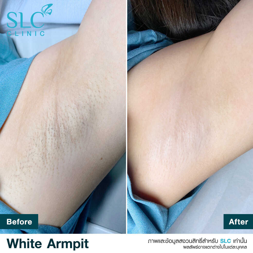 White Armpit Program_โปรแกรม รักแร้ขาว