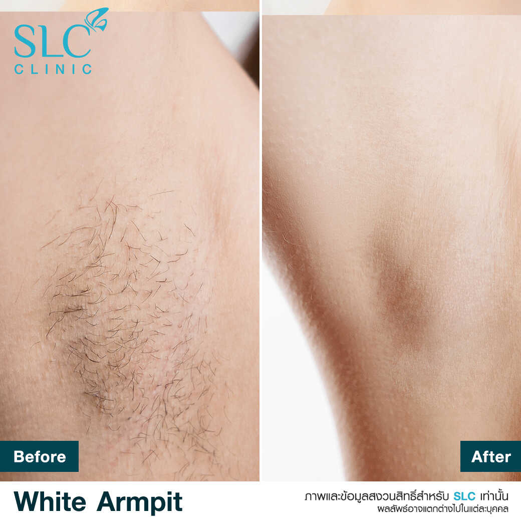 White Armpit Program_โปรแกรม รักแร้ขาว