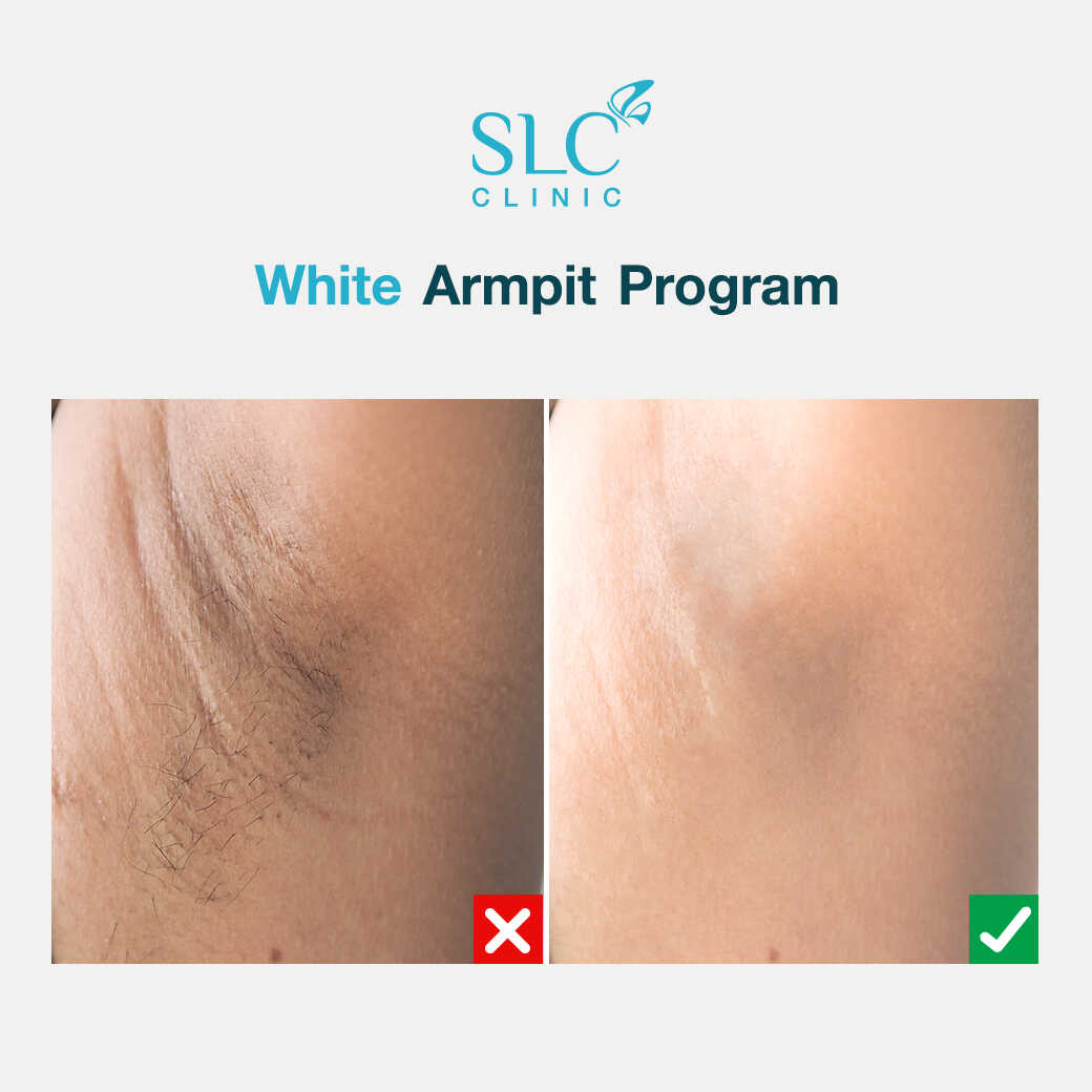 White Armpit Program_โปรแกรม รักแร้ขาว