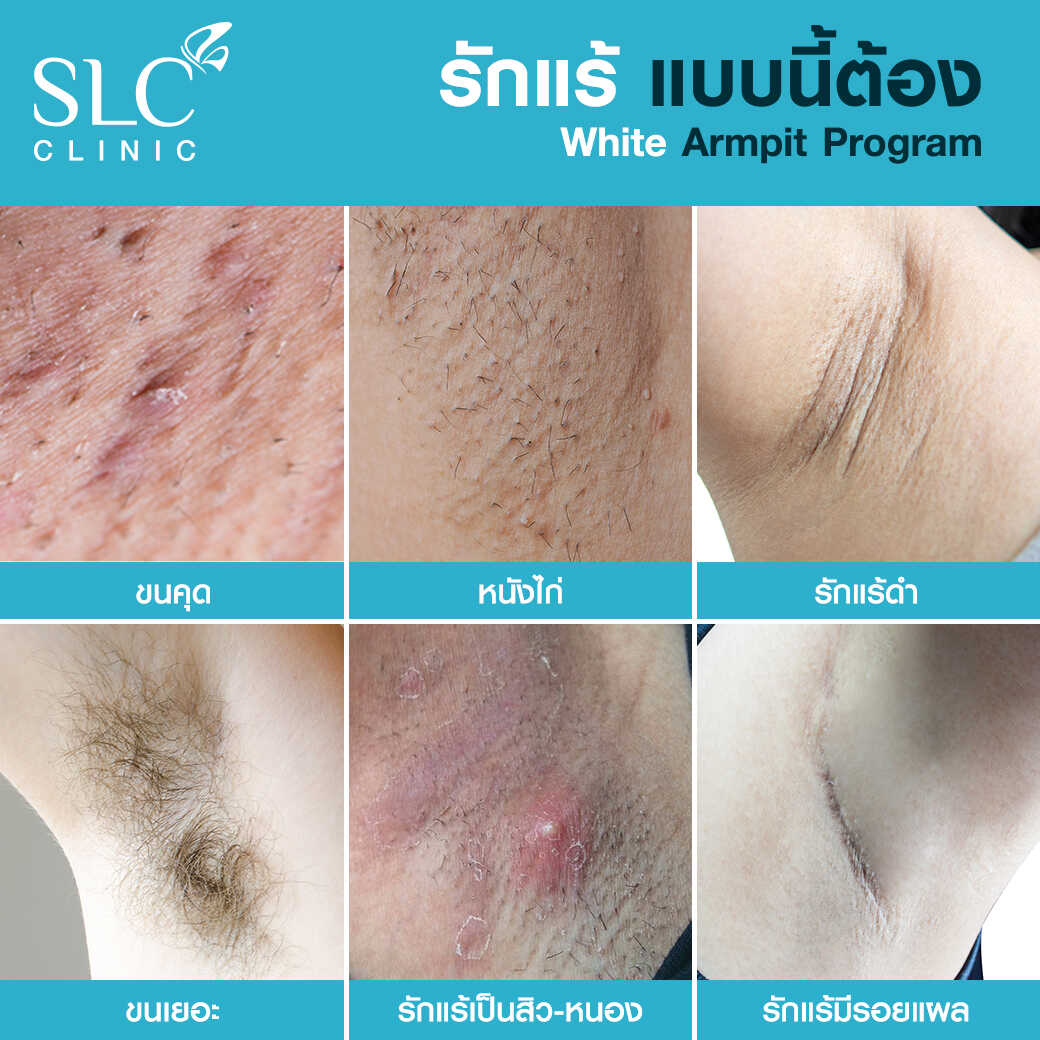 White Armpit Program_โปรแกรม รักแร้ขาว