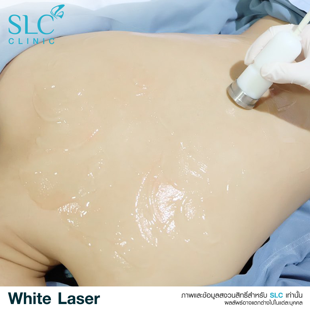 White Laser_เลเซอร์ผิวใส_เลอร์รักแร้ขาว_เลเซอร์รักฝ้า กระ