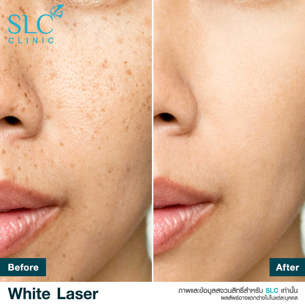 White Laser_เลเซอร์ผิวใส_เลอร์รักแร้ขาว_เลเซอร์รักฝ้า กระ