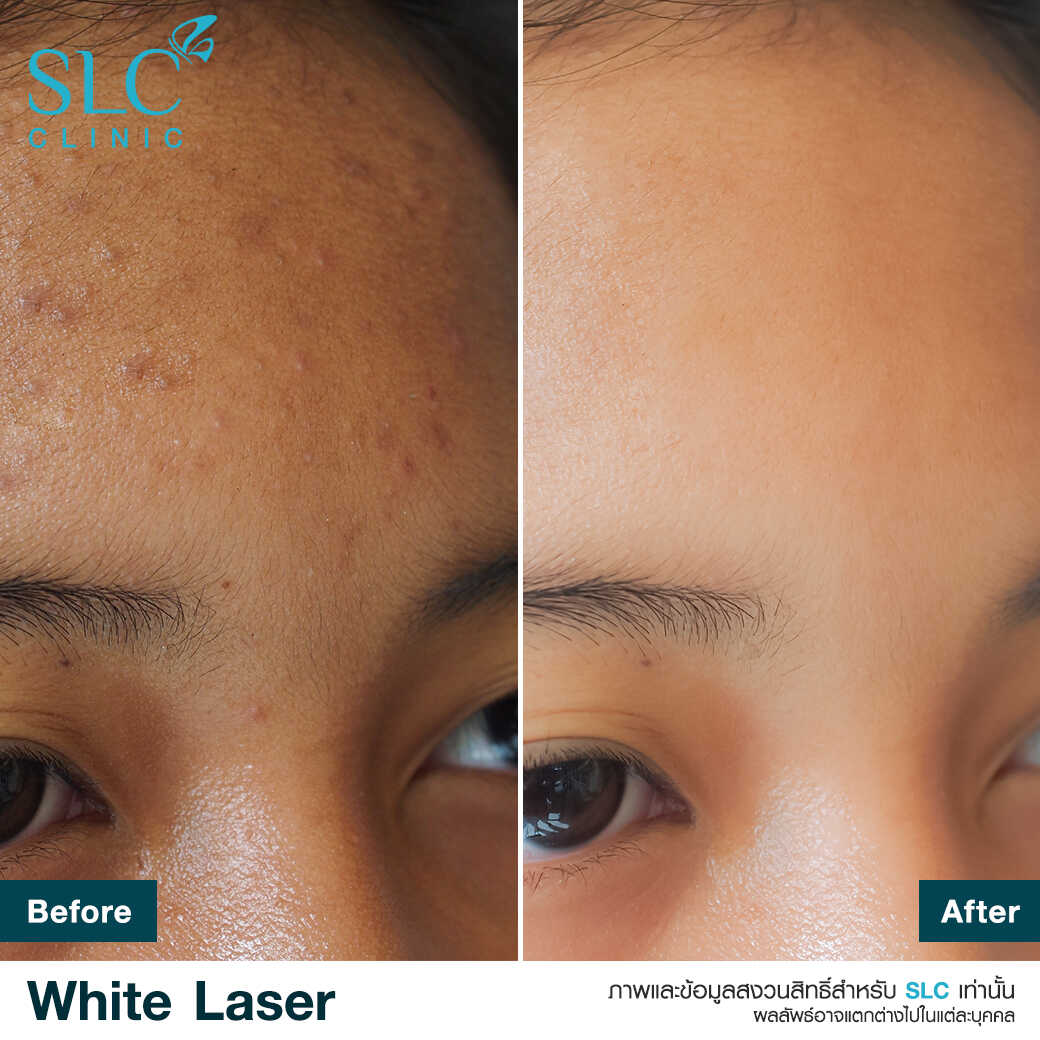 White Laser_เลเซอร์ผิวใส_เลอร์รักแร้ขาว_เลเซอร์รักฝ้า กระ