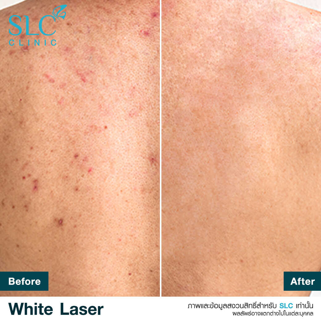 White Laser_เลเซอร์ผิวใส_เลอร์รักแร้ขาว_เลเซอร์รักฝ้า กระ