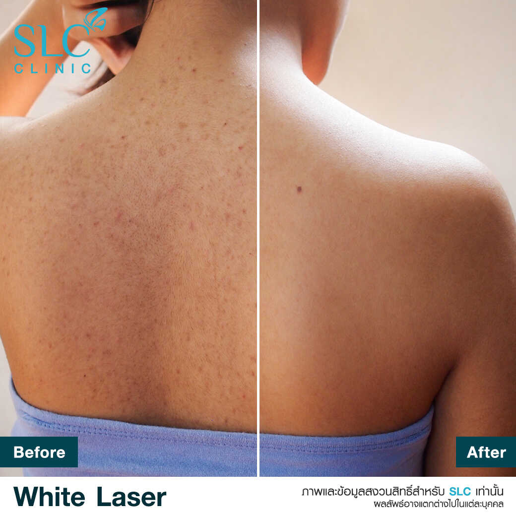 White Laser_เลเซอร์ผิวใส_เลอร์รักแร้ขาว_เลเซอร์รักฝ้า กระ