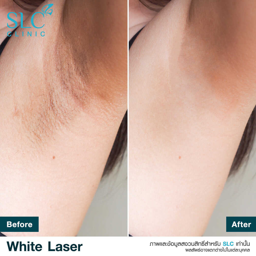 White Laser_เลเซอร์ผิวใส_เลอร์รักแร้ขาว_เลเซอร์รักฝ้า กระ