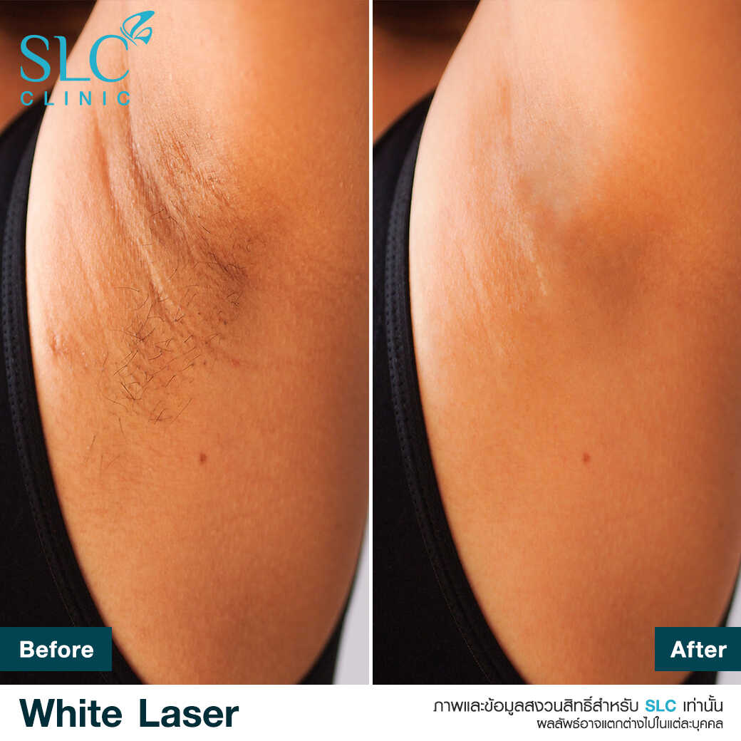 White Laser_เลเซอร์ผิวใส_เลอร์รักแร้ขาว_เลเซอร์รักฝ้า กระ