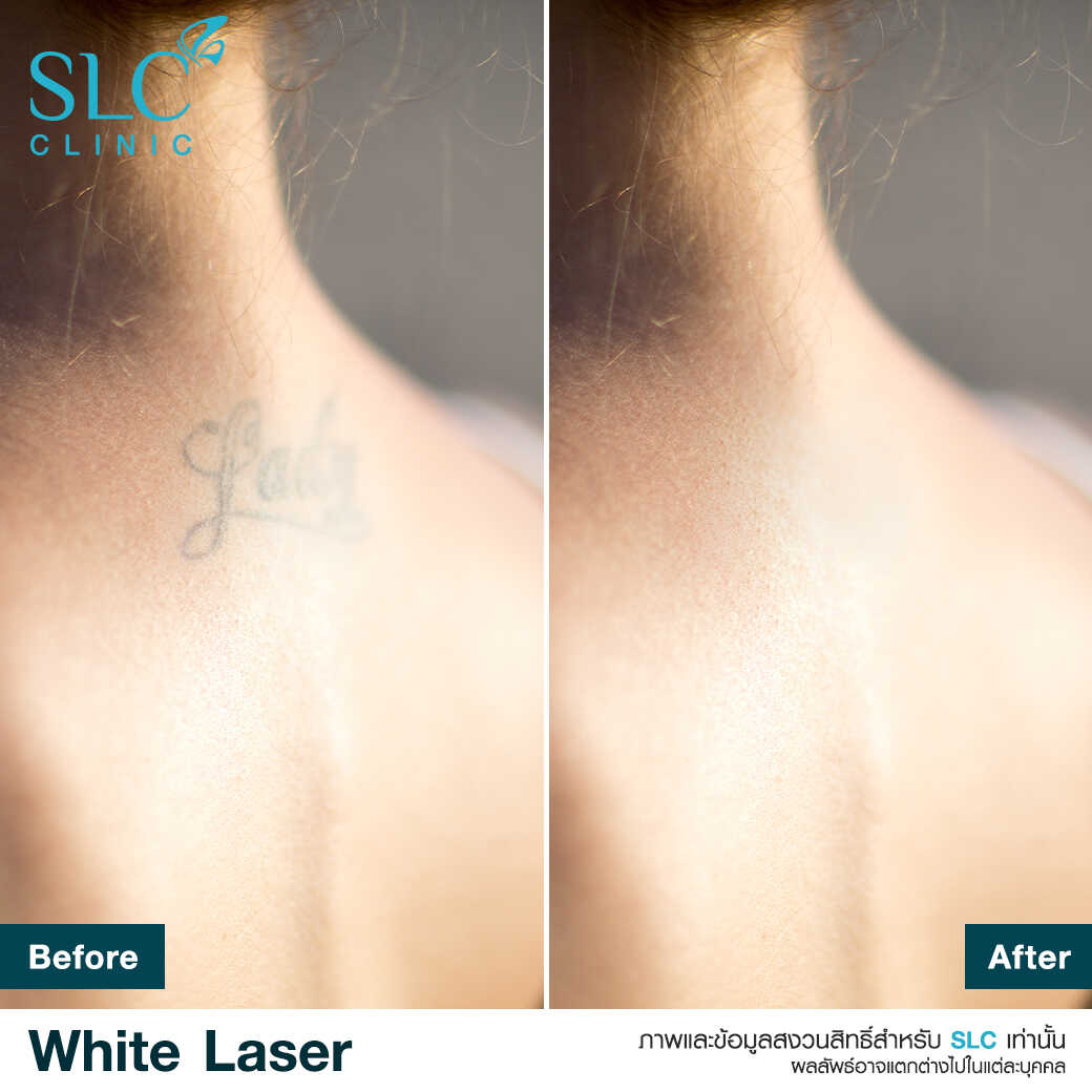 White Laser_เลเซอร์ผิวใส_เลอร์รักแร้ขาว_เลเซอร์รักฝ้า กระ