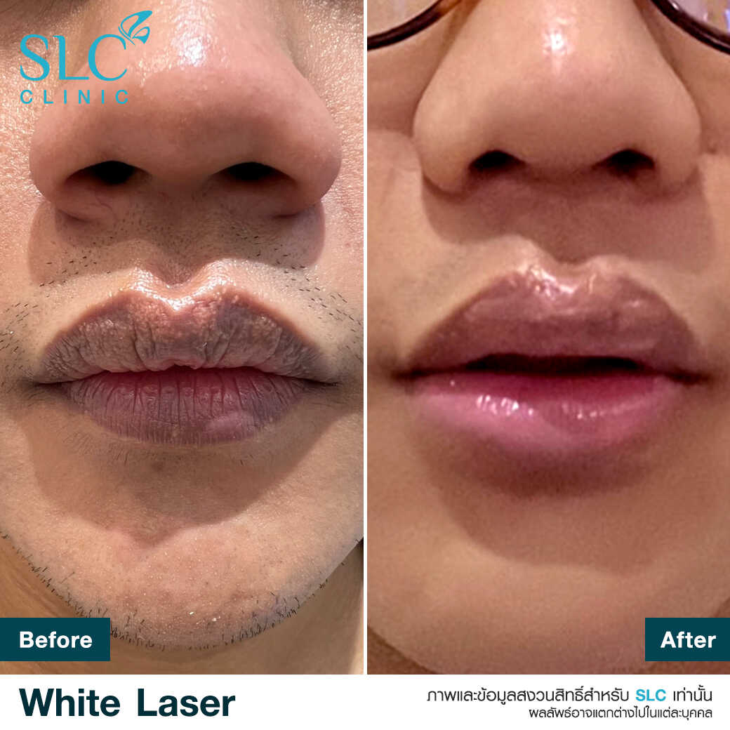 White Laser_เลเซอร์ผิวใส_เลอร์รักแร้ขาว_เลเซอร์รักฝ้า กระ