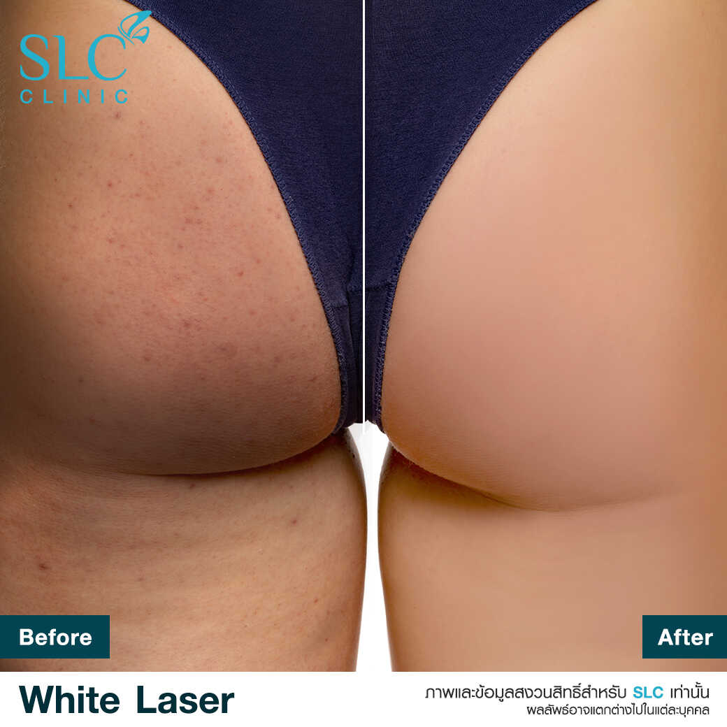 White Laser_เลเซอร์ผิวใส_เลอร์รักแร้ขาว_เลเซอร์รักฝ้า กระ