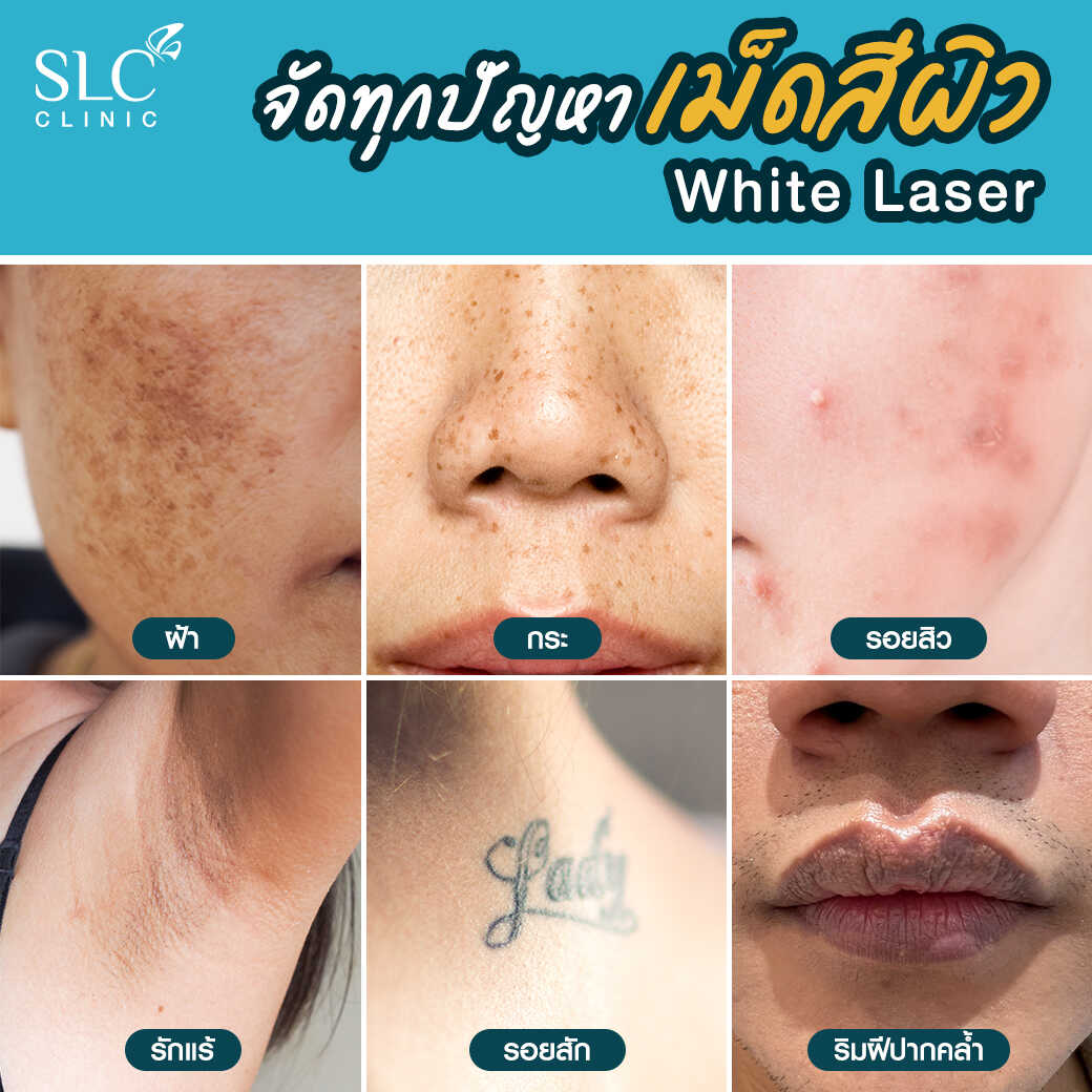 White Laser_เลเซอร์ผิวใส_เลอร์รักแร้ขาว_เลเซอร์รักฝ้า กระ