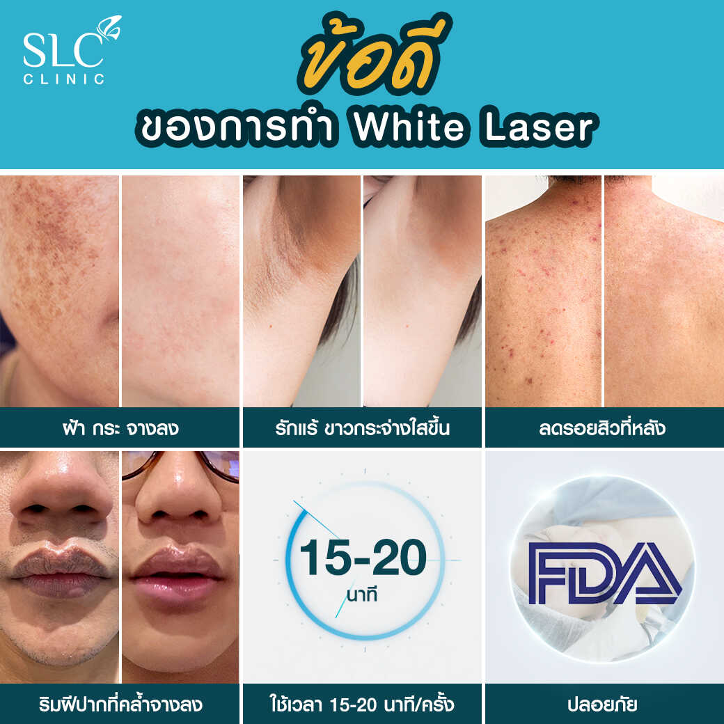 White Laser_เลเซอร์ผิวใส_เลอร์รักแร้ขาว_เลเซอร์รักฝ้า กระ