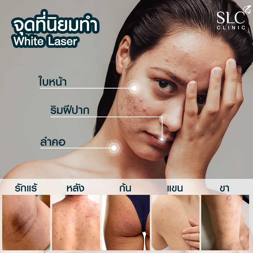 White Laser_เลเซอร์ผิวใส_เลอร์รักแร้ขาว_เลเซอร์รักฝ้า กระ