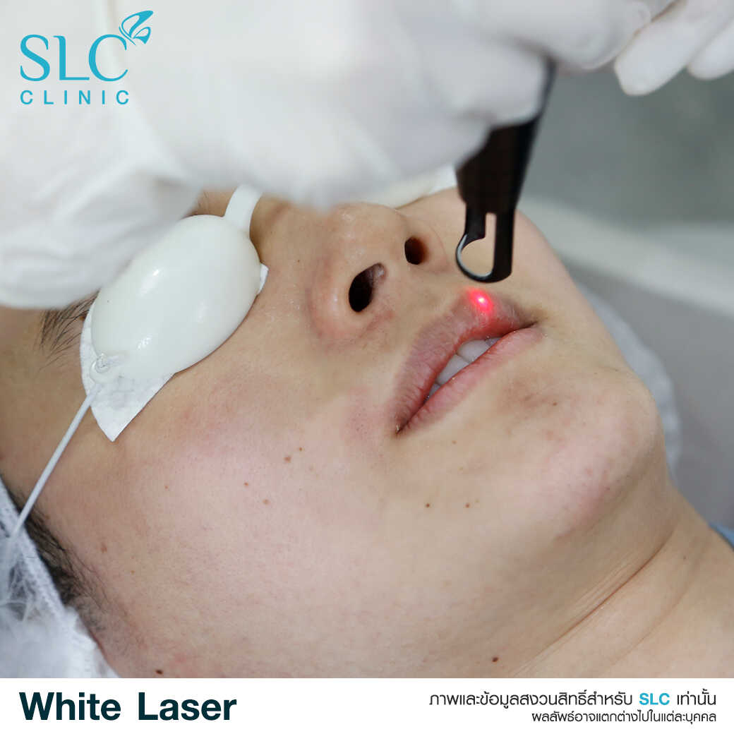 White Laser_เลเซอร์ผิวใส_เลอร์รักแร้ขาว_เลเซอร์รักฝ้า กระ