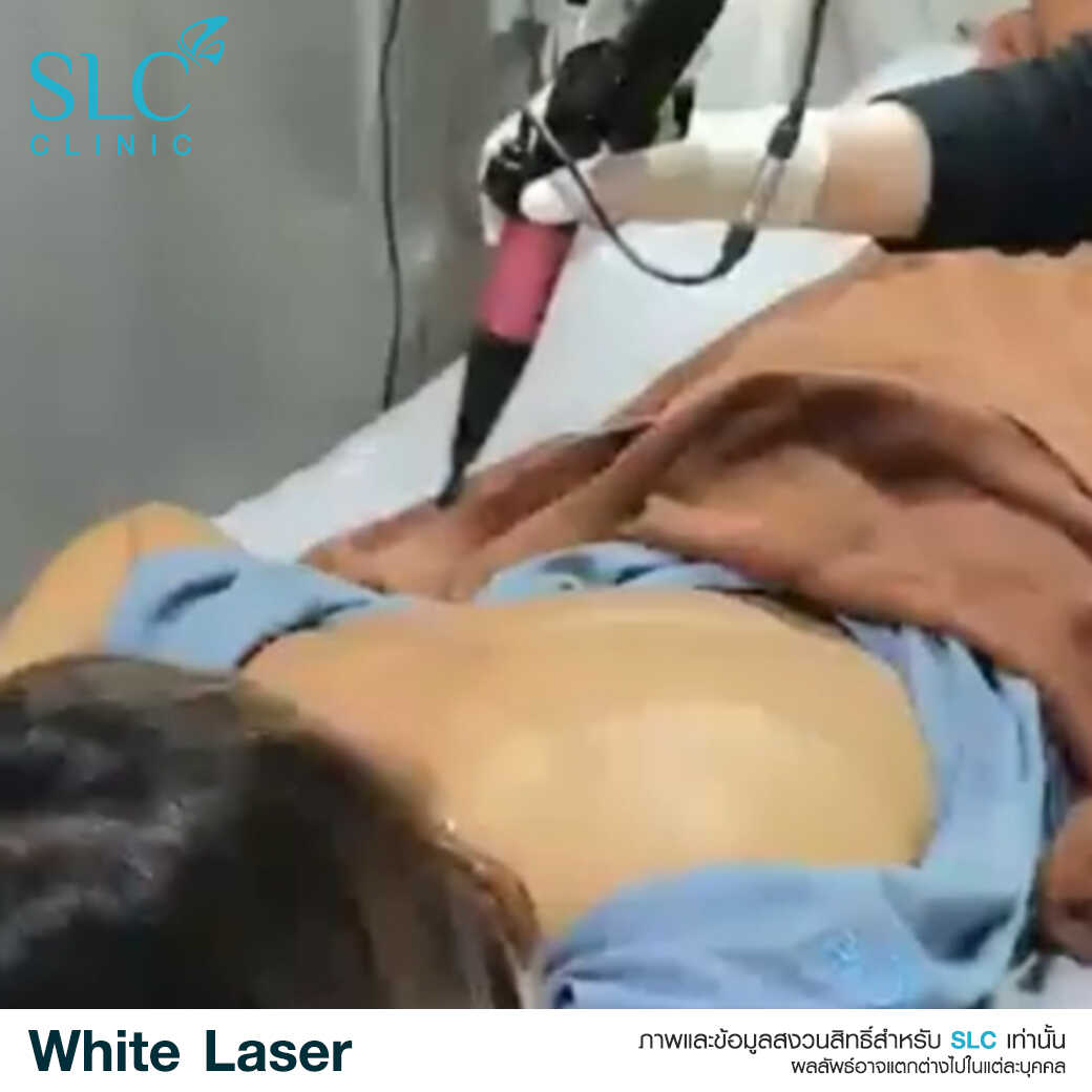 White Laser_เลเซอร์ผิวใส_เลอร์รักแร้ขาว_เลเซอร์รักฝ้า กระ