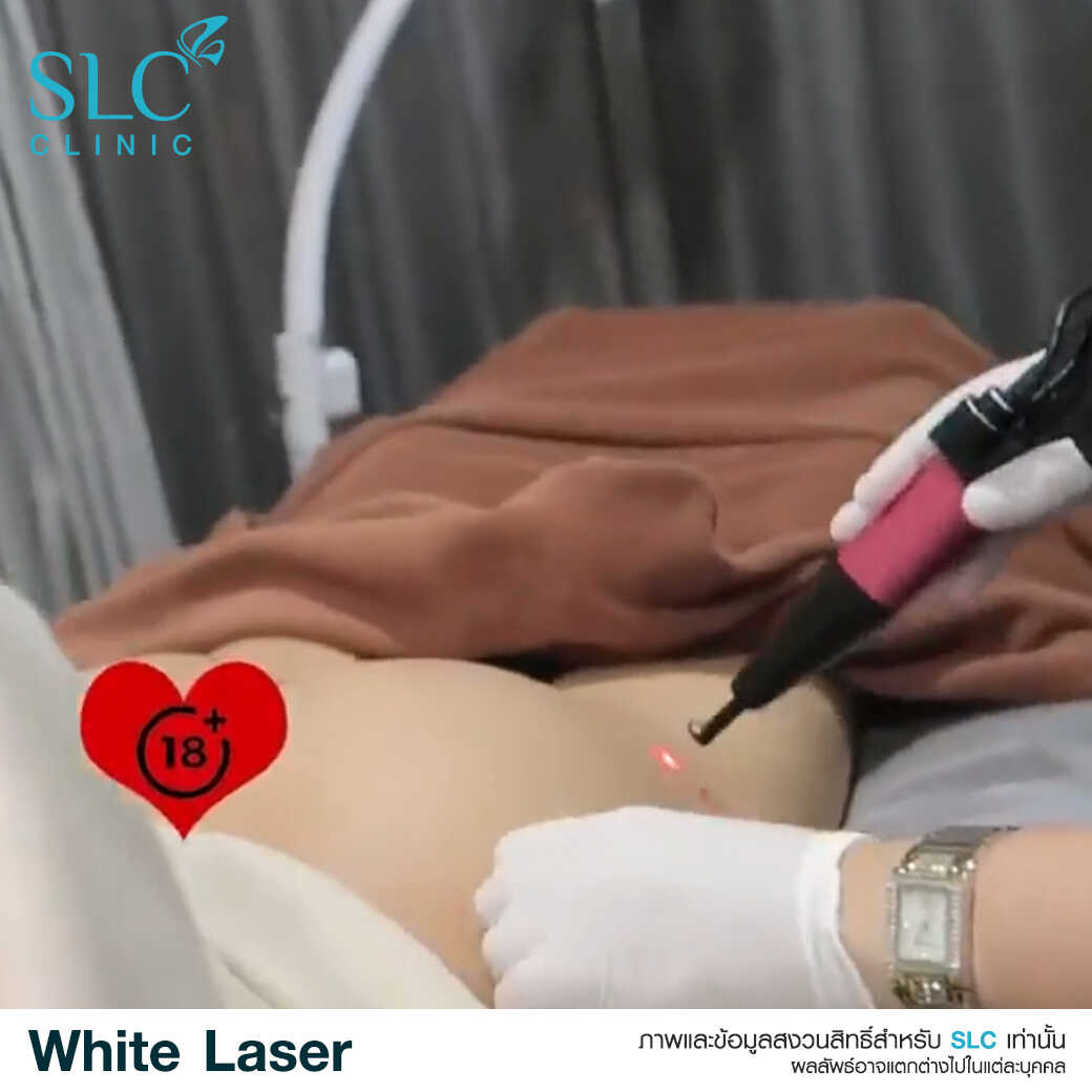 White Laser_เลเซอร์ผิวใส_เลอร์รักแร้ขาว_เลเซอร์รักฝ้า กระ