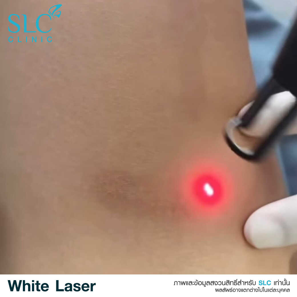 White Laser_เลเซอร์ผิวใส_เลอร์รักแร้ขาว_เลเซอร์รักฝ้า กระ