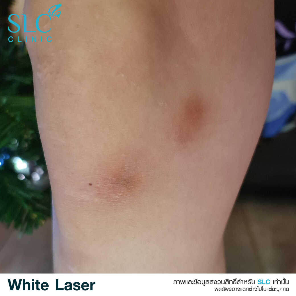 White Laser_เลเซอร์ผิวใส_เลอร์รักแร้ขาว_เลเซอร์รักฝ้า กระ