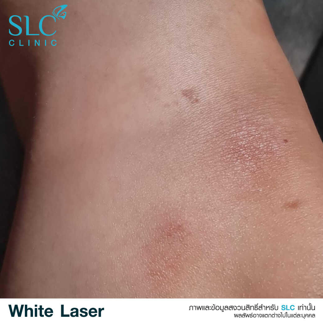 White Laser_เลเซอร์ผิวใส_เลอร์รักแร้ขาว_เลเซอร์รักฝ้า กระ