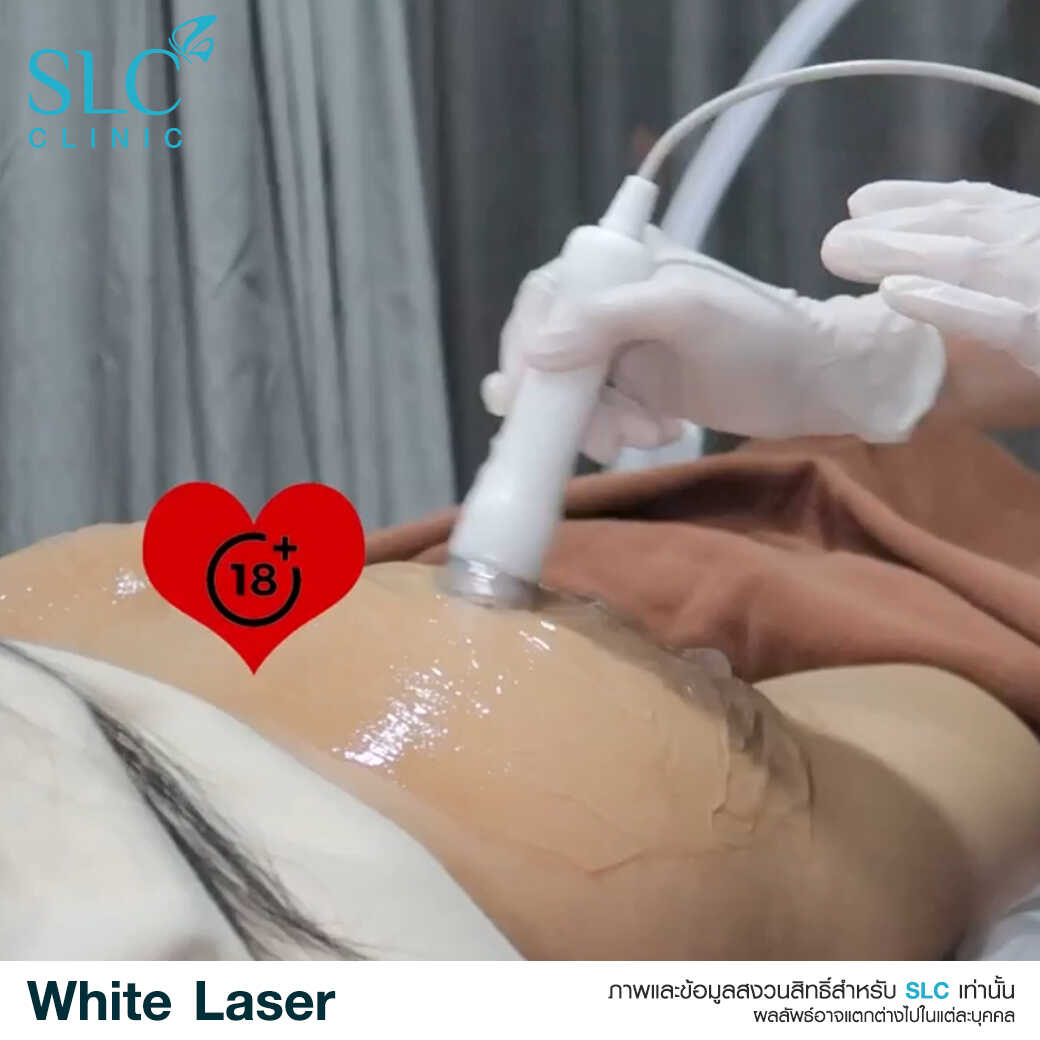 White Laser_เลเซอร์ผิวใส_เลอร์รักแร้ขาว_เลเซอร์รักฝ้า กระ