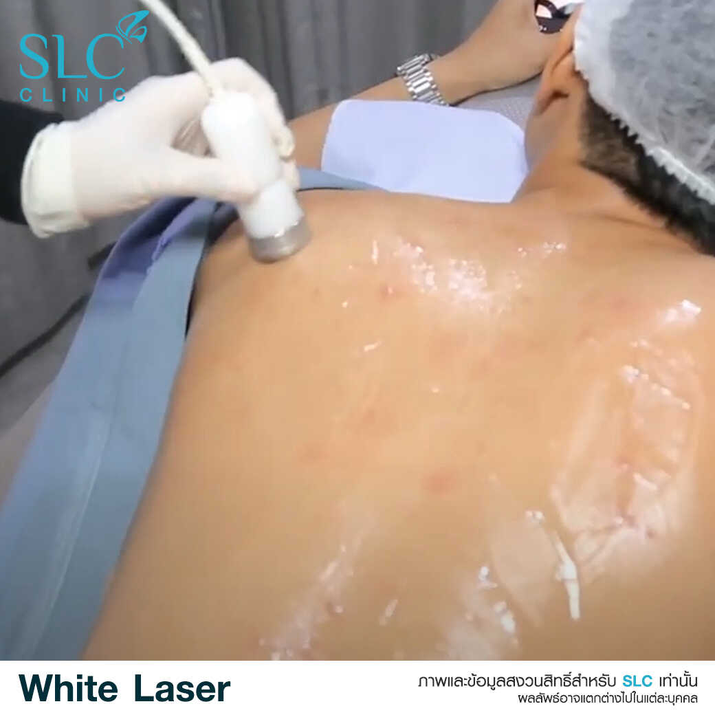 White Laser_เลเซอร์ผิวใส_เลอร์รักแร้ขาว_เลเซอร์รักฝ้า กระ