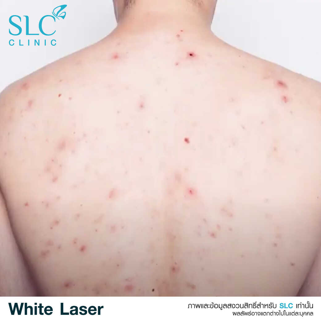 White Laser_เลเซอร์ผิวใส_เลอร์รักแร้ขาว_เลเซอร์รักฝ้า กระ