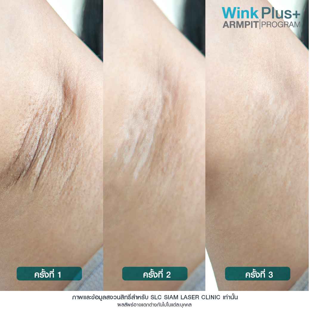 Wink Plus Armpit_โปรแกรมรักแร้ขาว