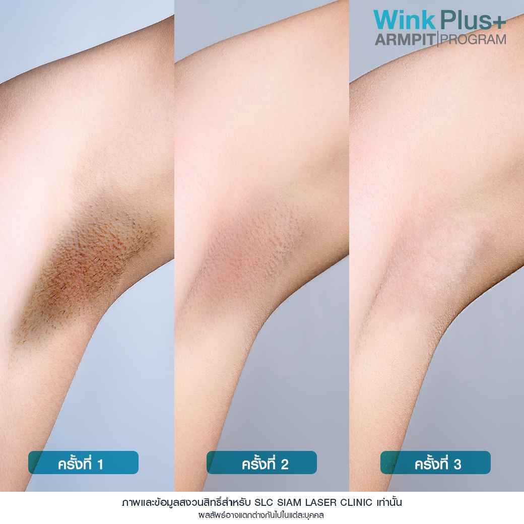 Wink Plus Armpit_โปรแกรมรักแร้ขาว