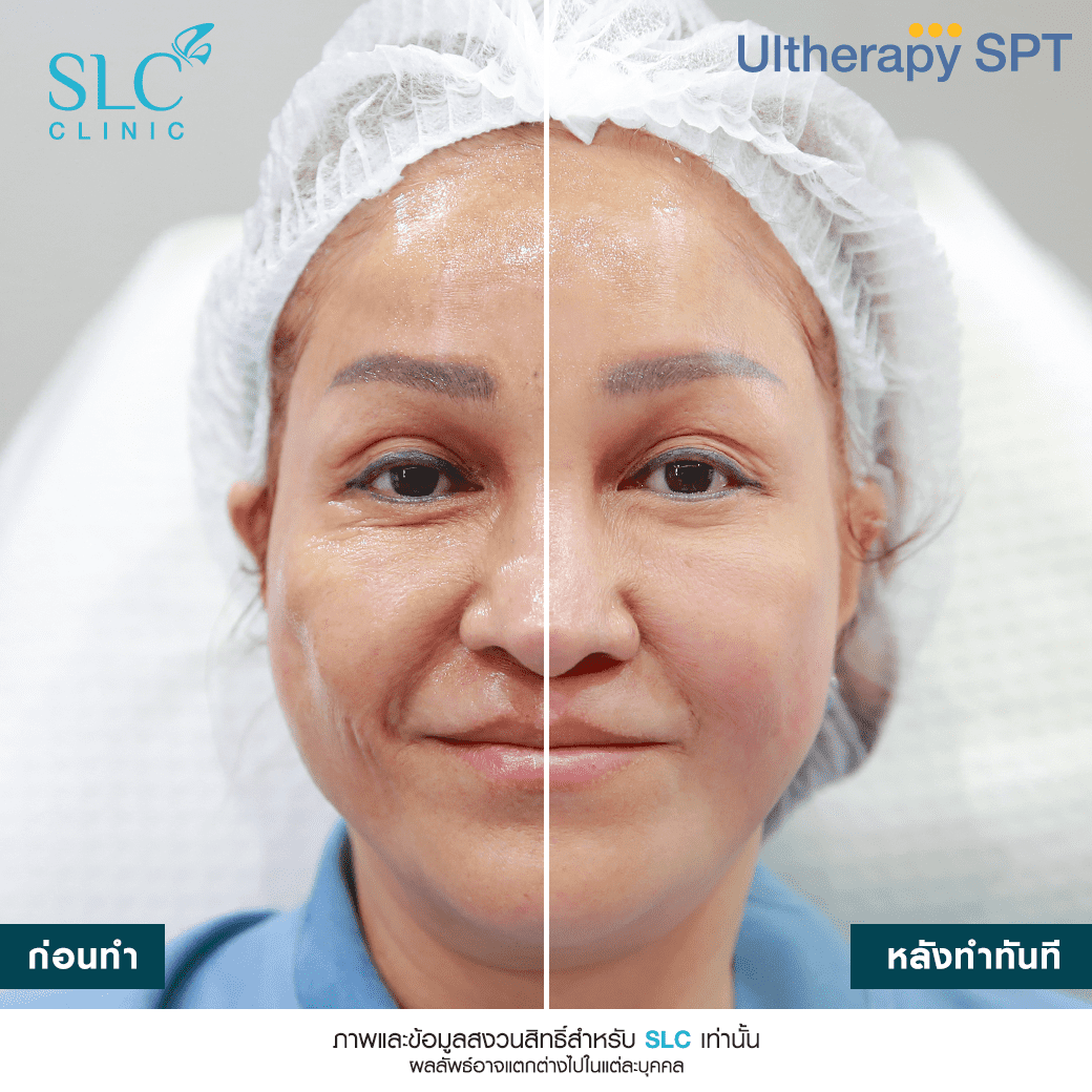 ยกกระชับ Linelift_Ultherapy SPT_แม่มด